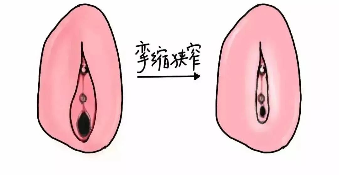 怎样判断自己得了外阴白斑 怎样判断自己得了外阴白斑