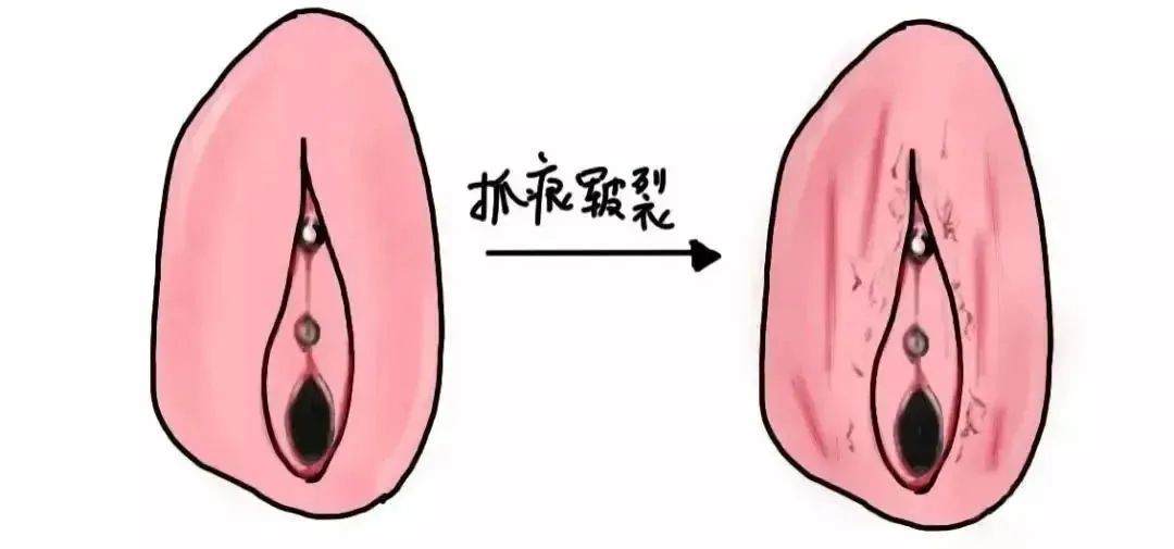 怎样判断自己得了外阴白斑 怎样判断自己得了外阴白斑