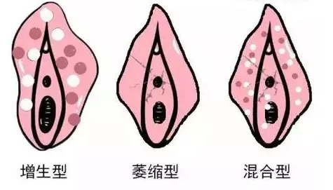 外阴白斑有哪些类型? 外阴白斑有哪些类型?