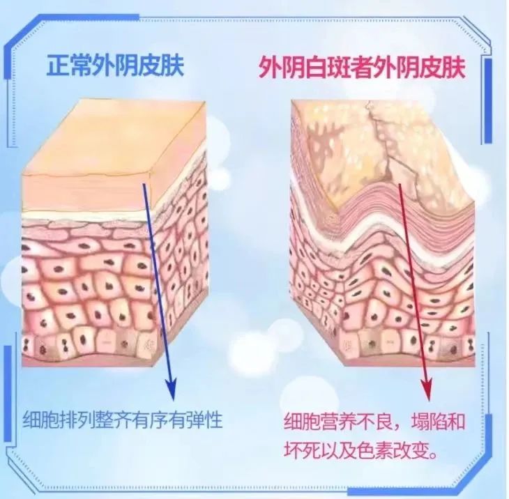 微循环又是如何导致外阴白斑疾病的？