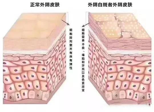 外阴白斑真的能自愈吗？